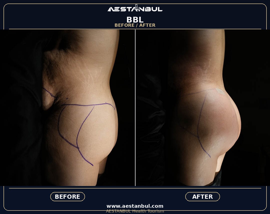 BBL surgery Turkey recovery and clinic selection