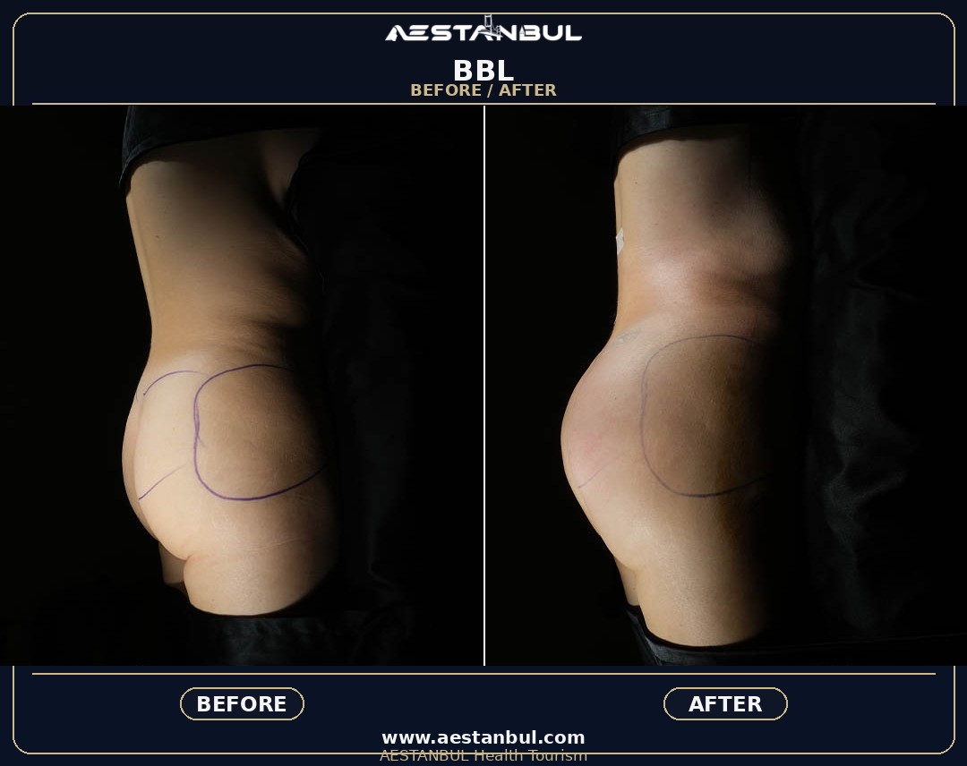 Brazilian butt lift in Istanbul consultation