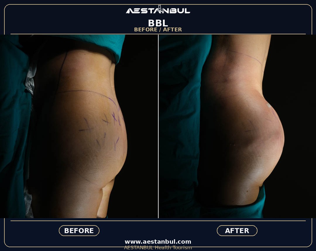 BBL surgery in Turkey clinic guidance