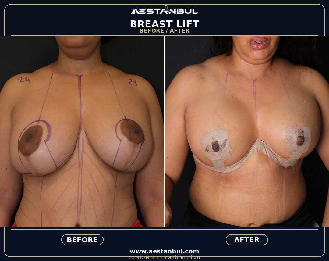breast lift Turkey clinic guidance