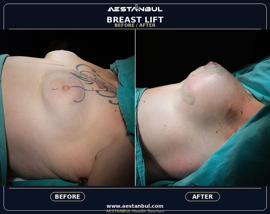 breast surgery Istanbul treatment planning