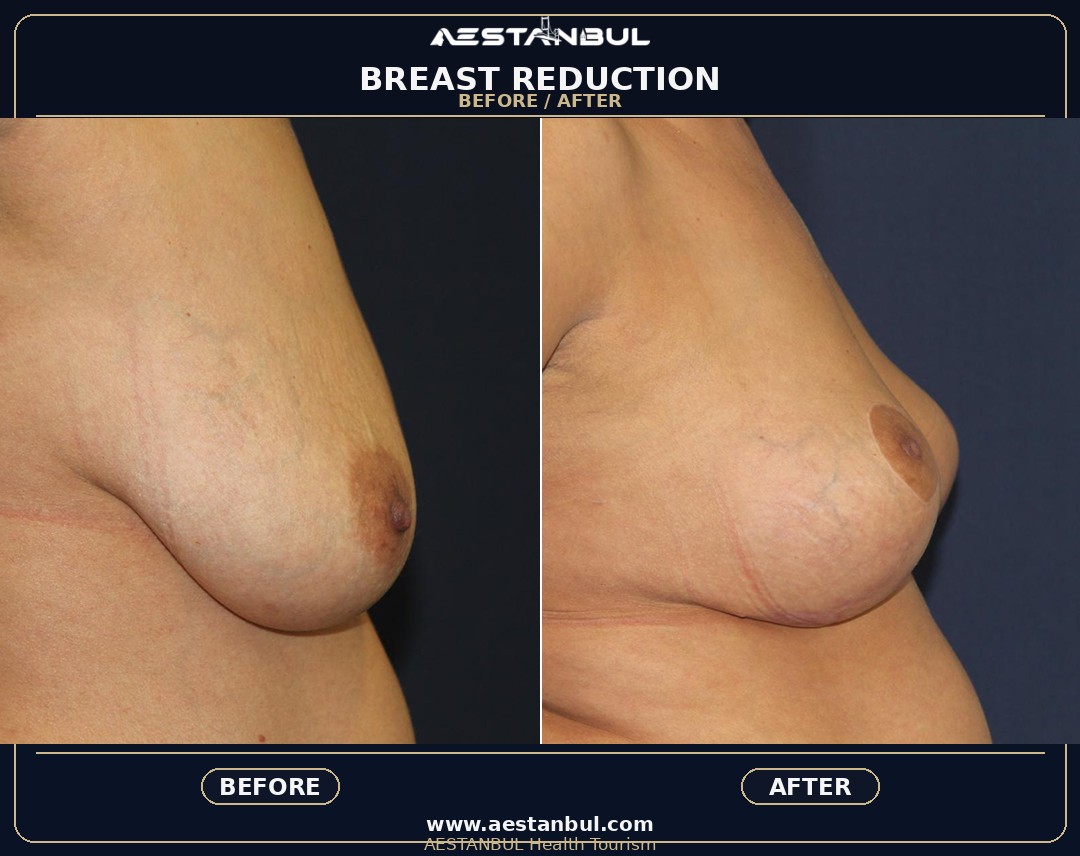 breast reduction Turkey clinic guidance