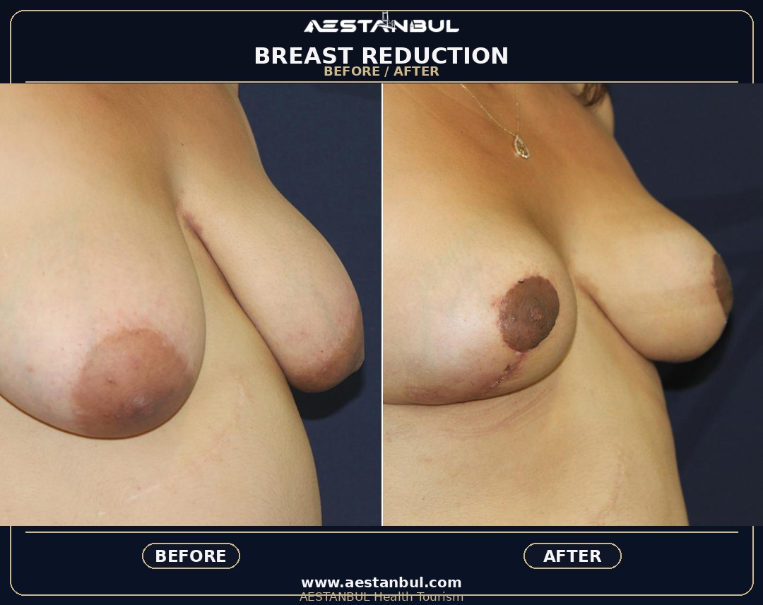breast augmentation Turkey breast lift Turkey breast reduction Turkey