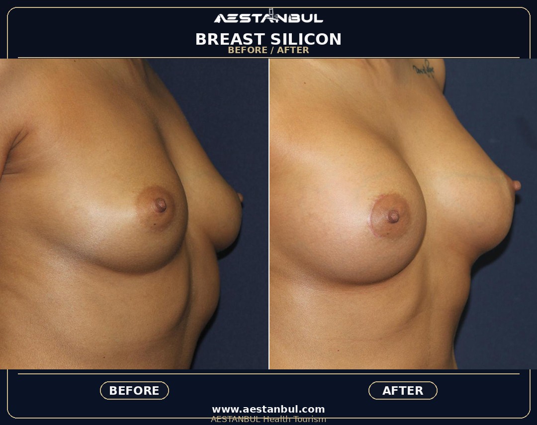 breast surgery Istanbul clinic guidance