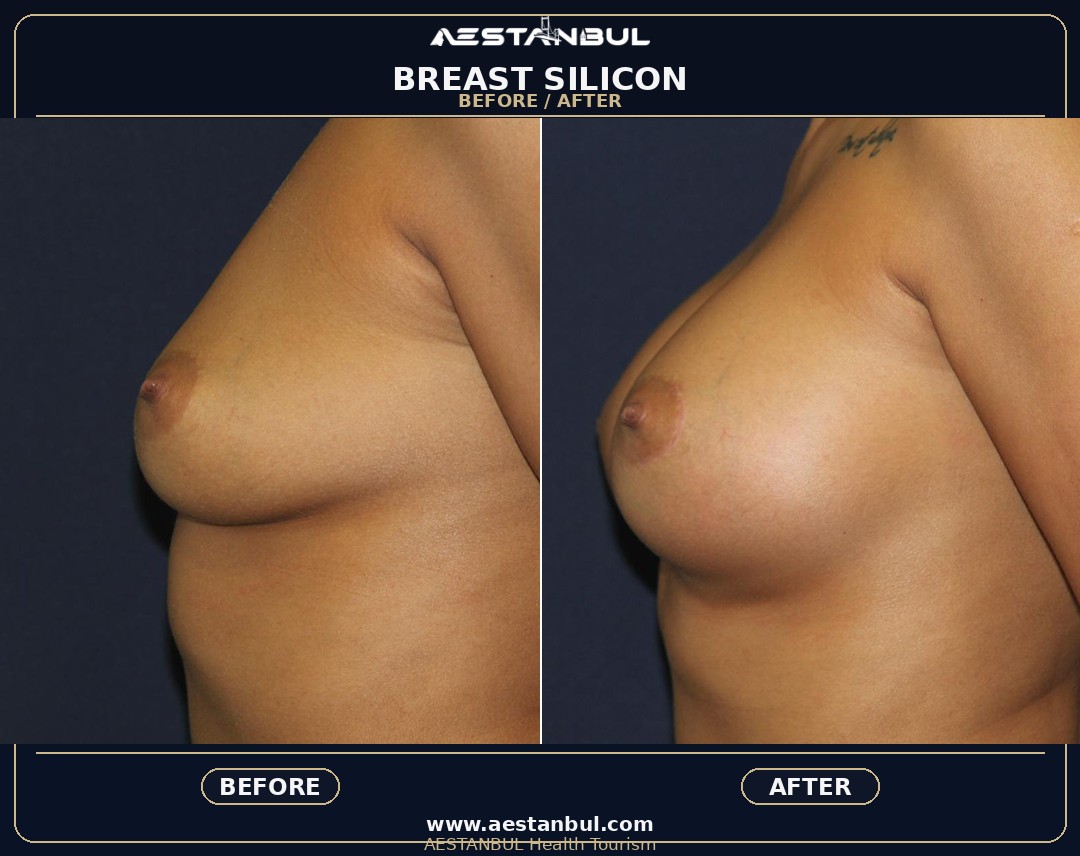breast augmentation Turkey clinic guidance in Istanbul