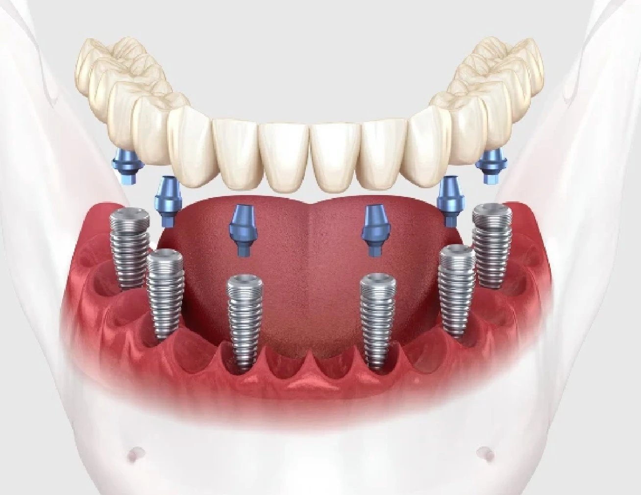 All on 6 implants in Turkey showing implant placement and restoration process