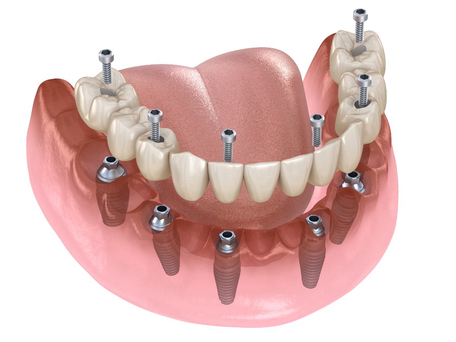 All on 6 in Turkey – Full mouth dental implants with advanced technology and natural results