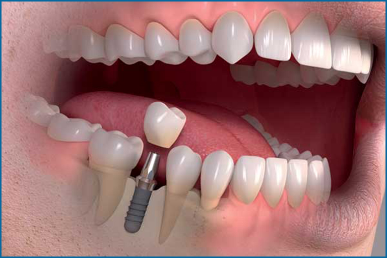 Benefits of placing Immediate dental implants in Turkey – faster healing and natural results