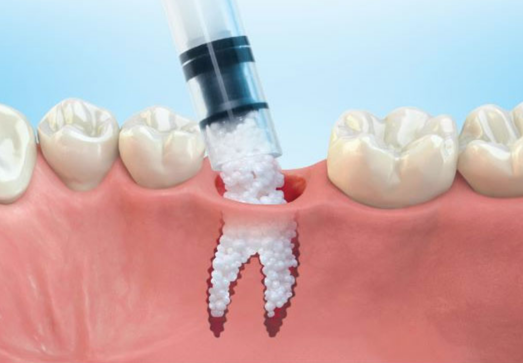 Before and after Bone Powder Graft in Turkey – improved jawbone density for implants