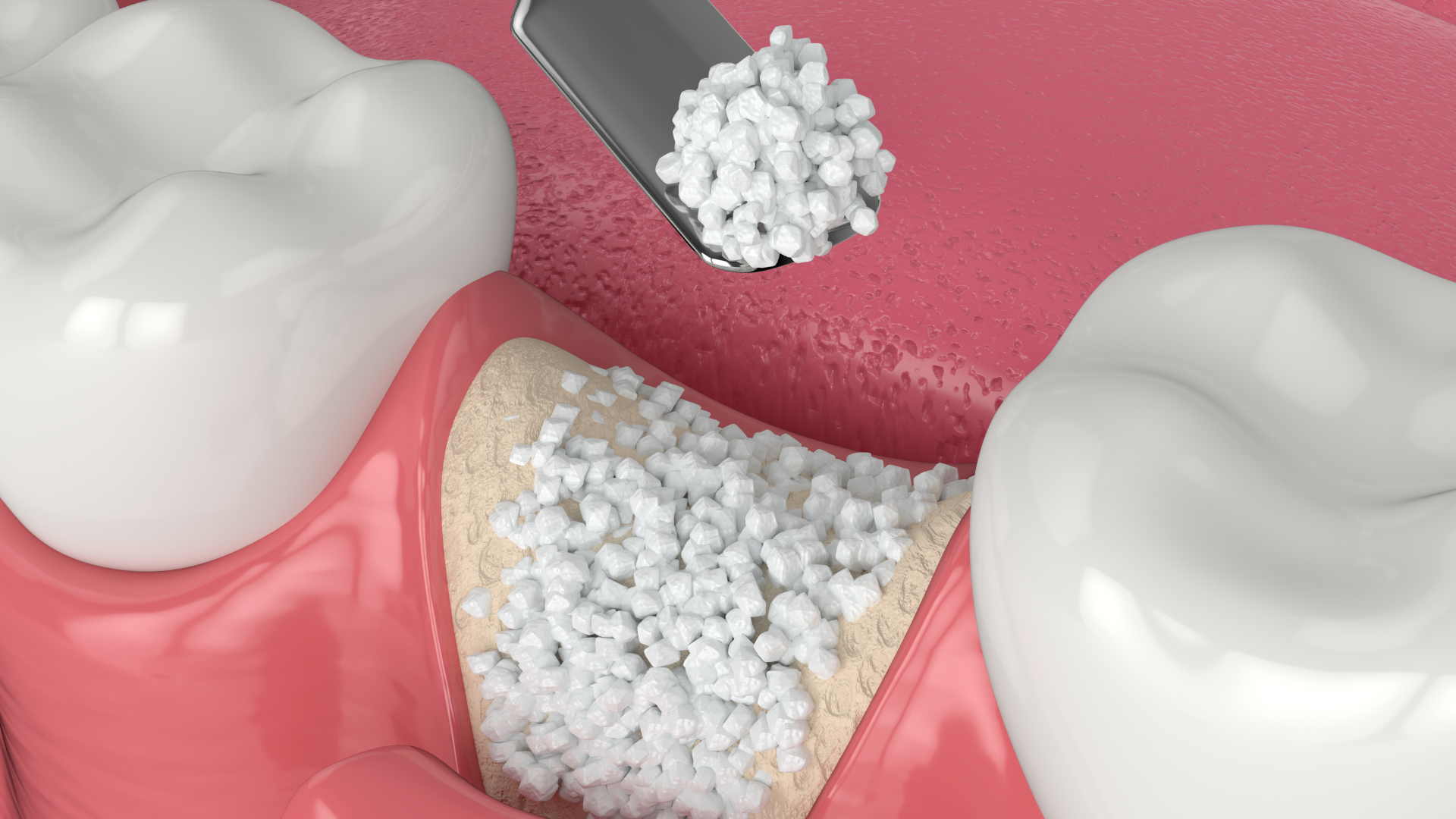 Bone Powder Graft in Turkey – Bone augmentation using sterile bone powder for dental implants