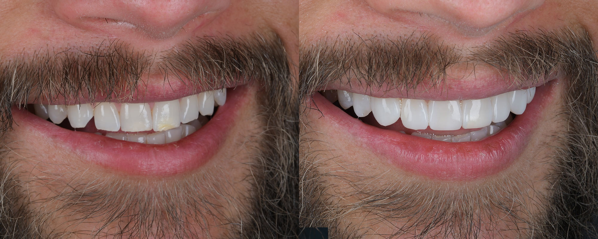 Composite Bonding in Turkey – Fixing chips and gaps with natural-looking results