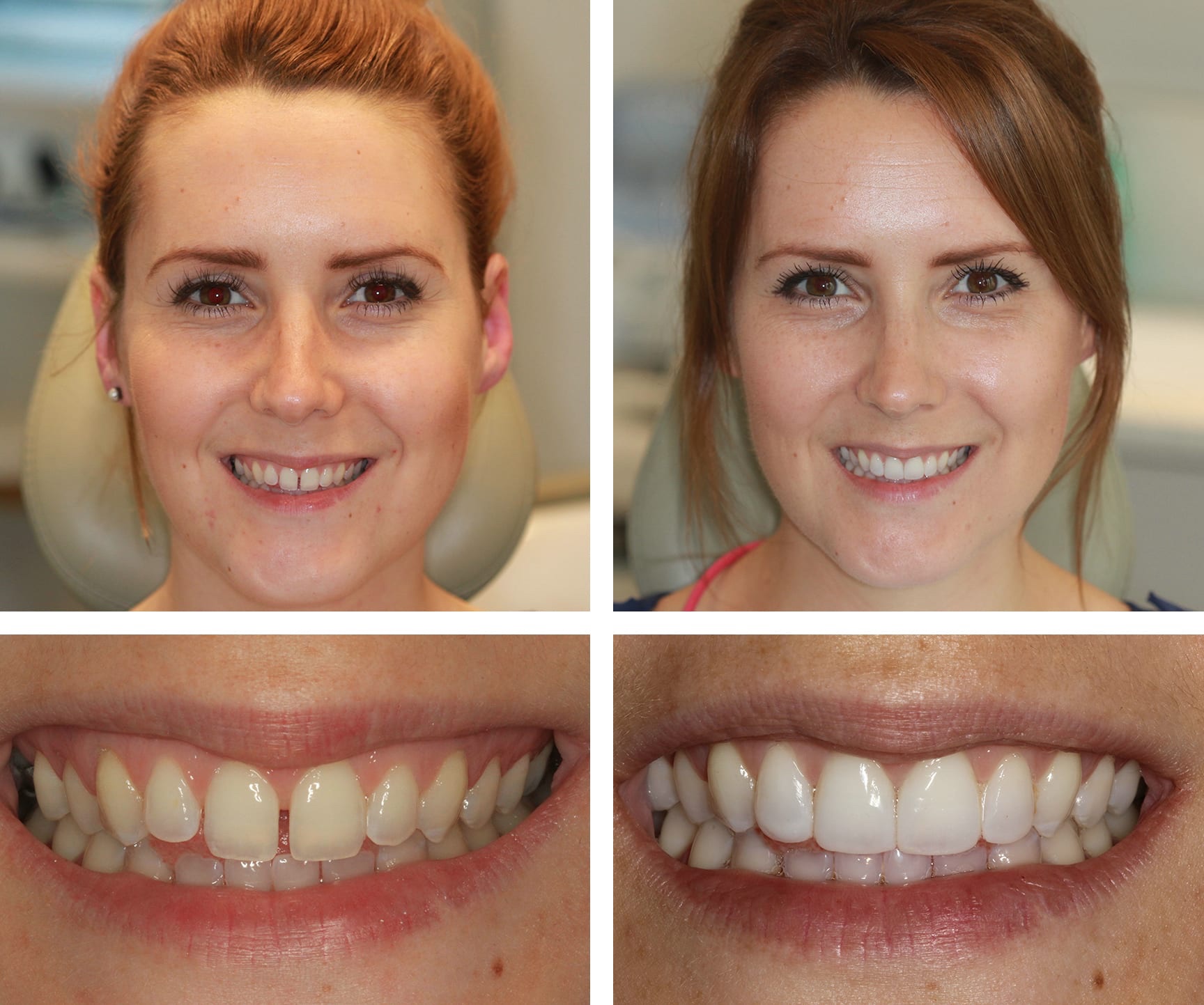 Before and after results of Composite Bonding in Turkey – natural aesthetic outcome