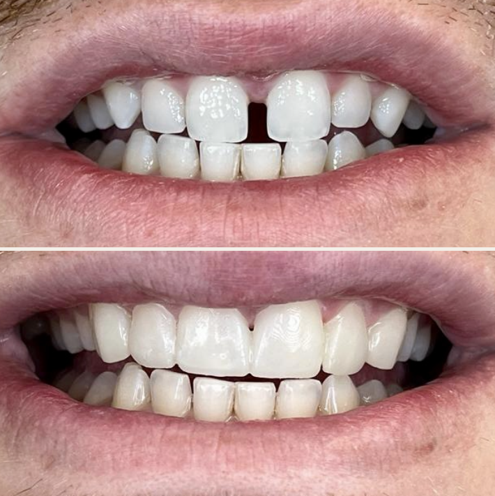 Composite Bonding in Turkey showing before and after tooth repair