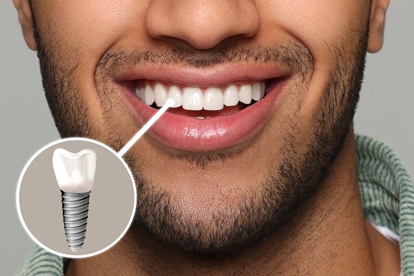 Dental Implant Treatment in Turkey – Expert dental care and natural-looking results