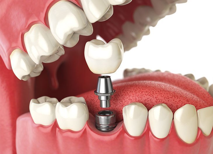 Dental implant treatment in Turkey showing before and after results