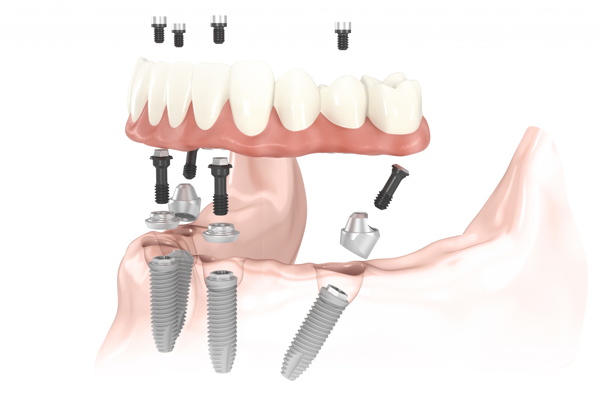 Various dental implant treatments in Turkey including single, multiple, and full mouth solutions