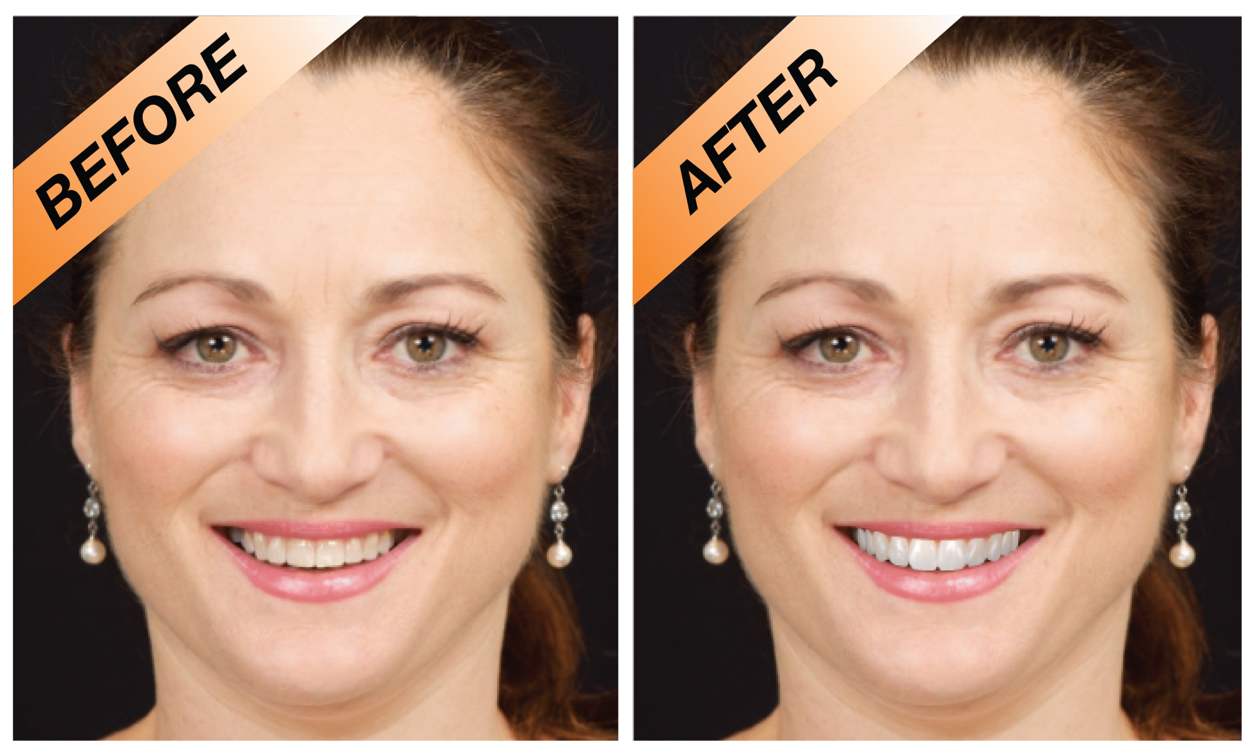 Patient enjoying their new smile after Digital Smile Design treatment in Turkey.