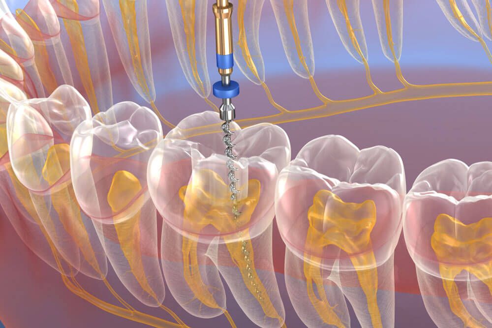 Endodontic Treatments in Turkey showing before and after results