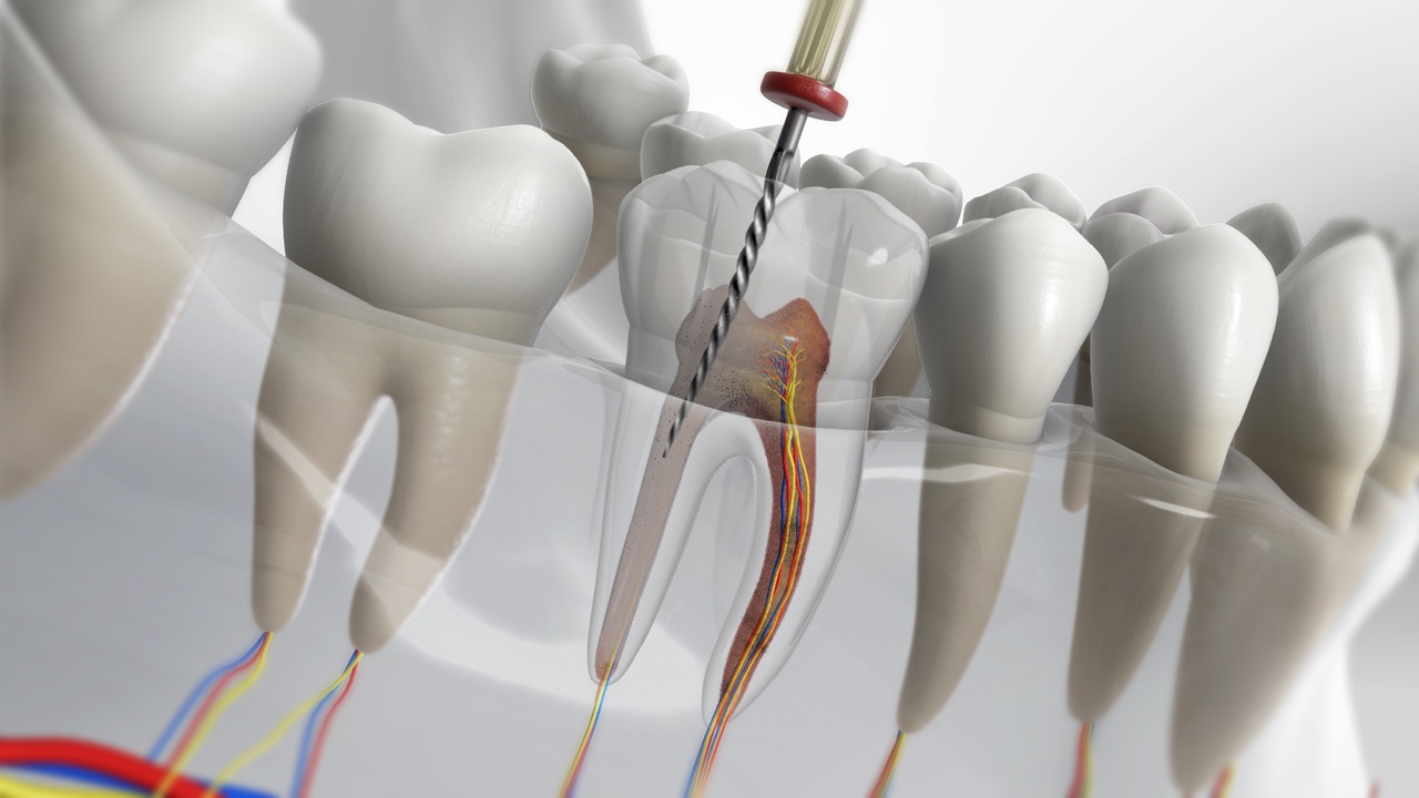 Endodontic Treatments in Turkey – Advanced root canal therapy for infected teeth