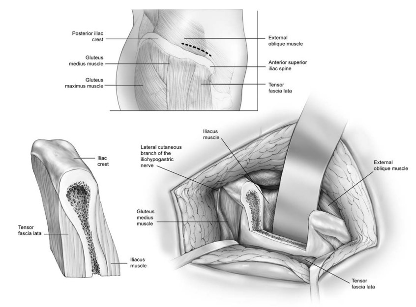Iliac Bone Graft in Turkey – Harvesting bone from hip for jaw reconstruction
