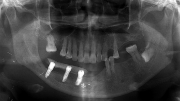 Before and after Iliac Bone Graft in Turkey – restored jawbone and facial symmetry