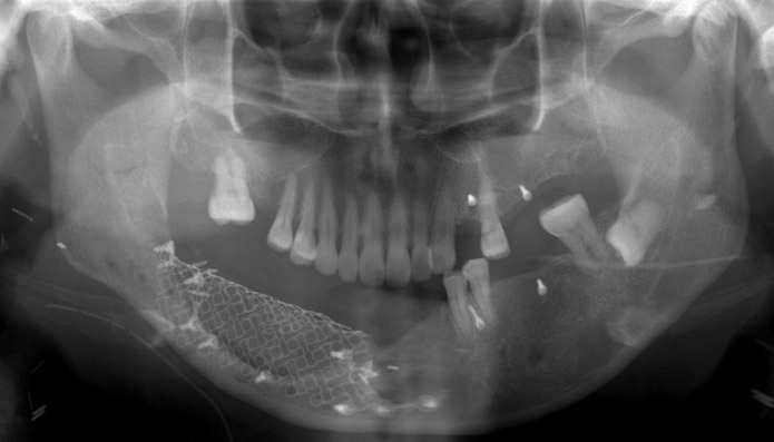 Iliac Bone Graft in Turkey – Istanbul skyline during recovery and medical tourism