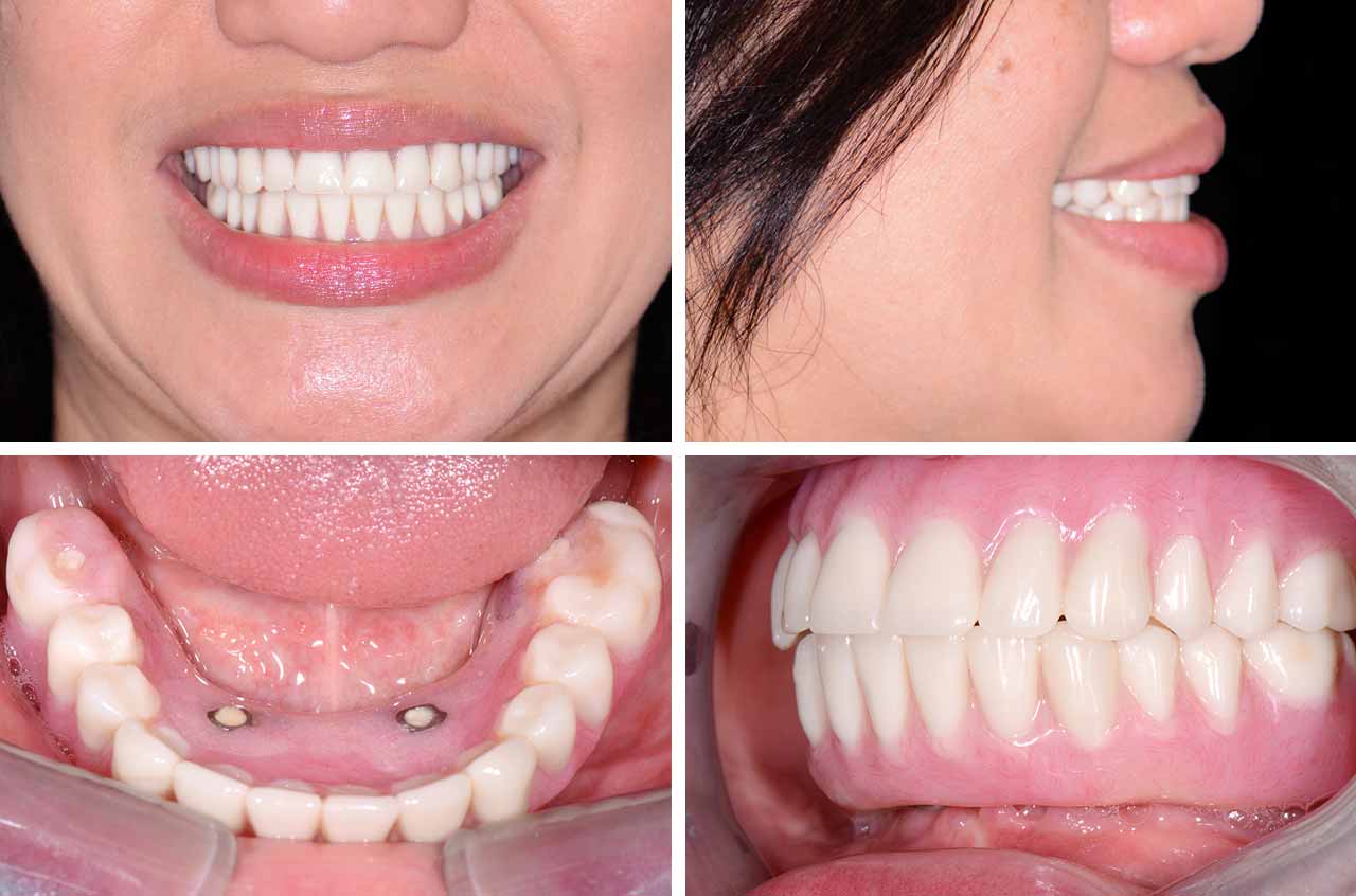 Immediate Dental Implant in Turkey – Same-day implant placement and temporary crown