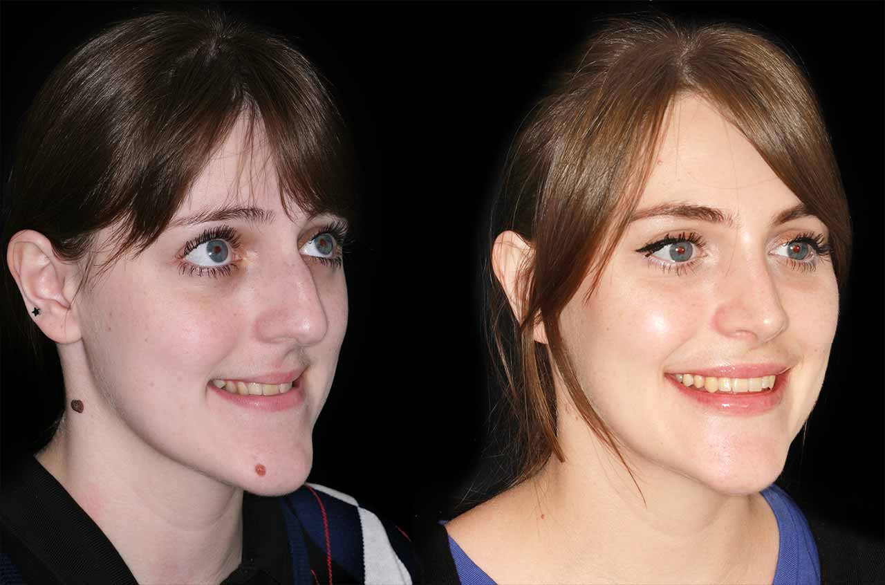 Before and after results of jaw surgery in Turkey – improved facial balance and smile aesthetics