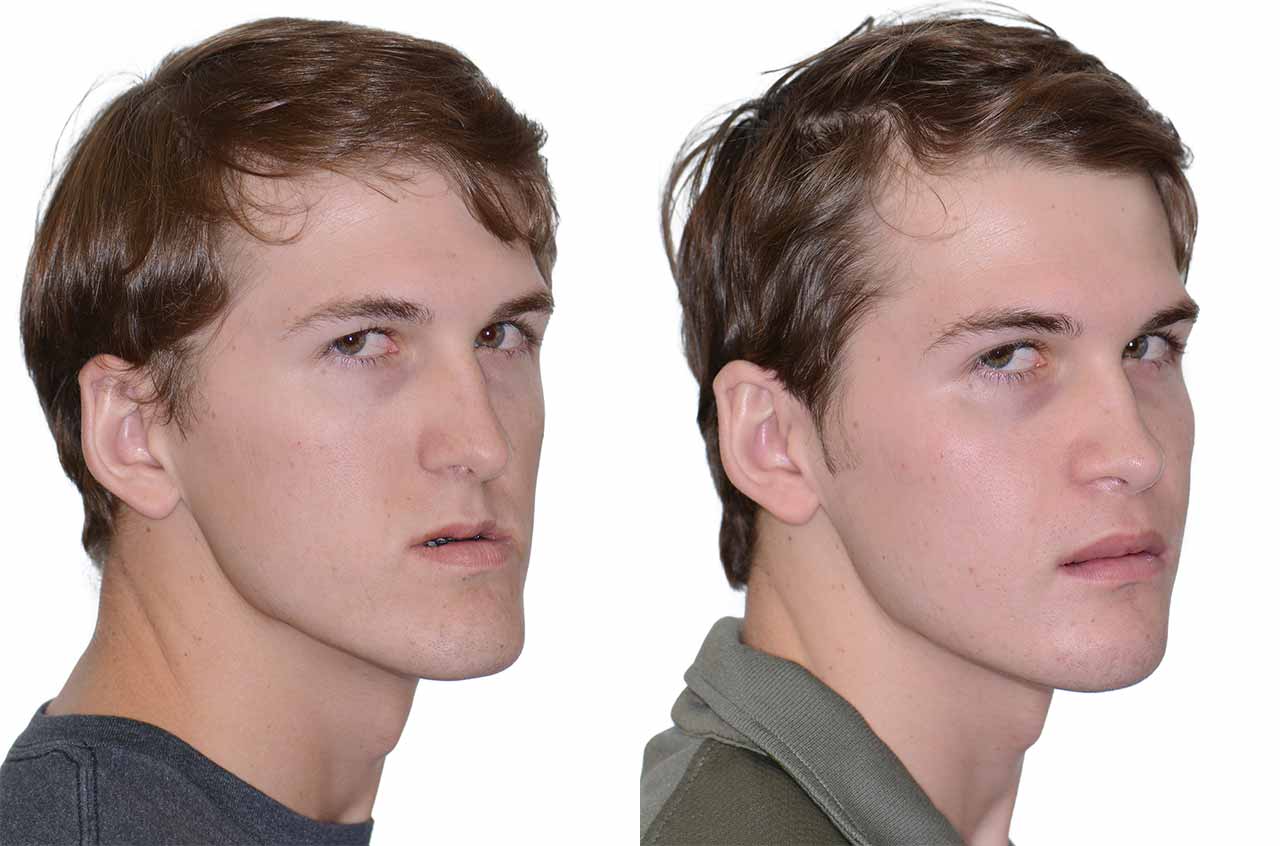 Jaw Surgery in Turkey – Expert orthognathic procedures for facial balance and bite correction