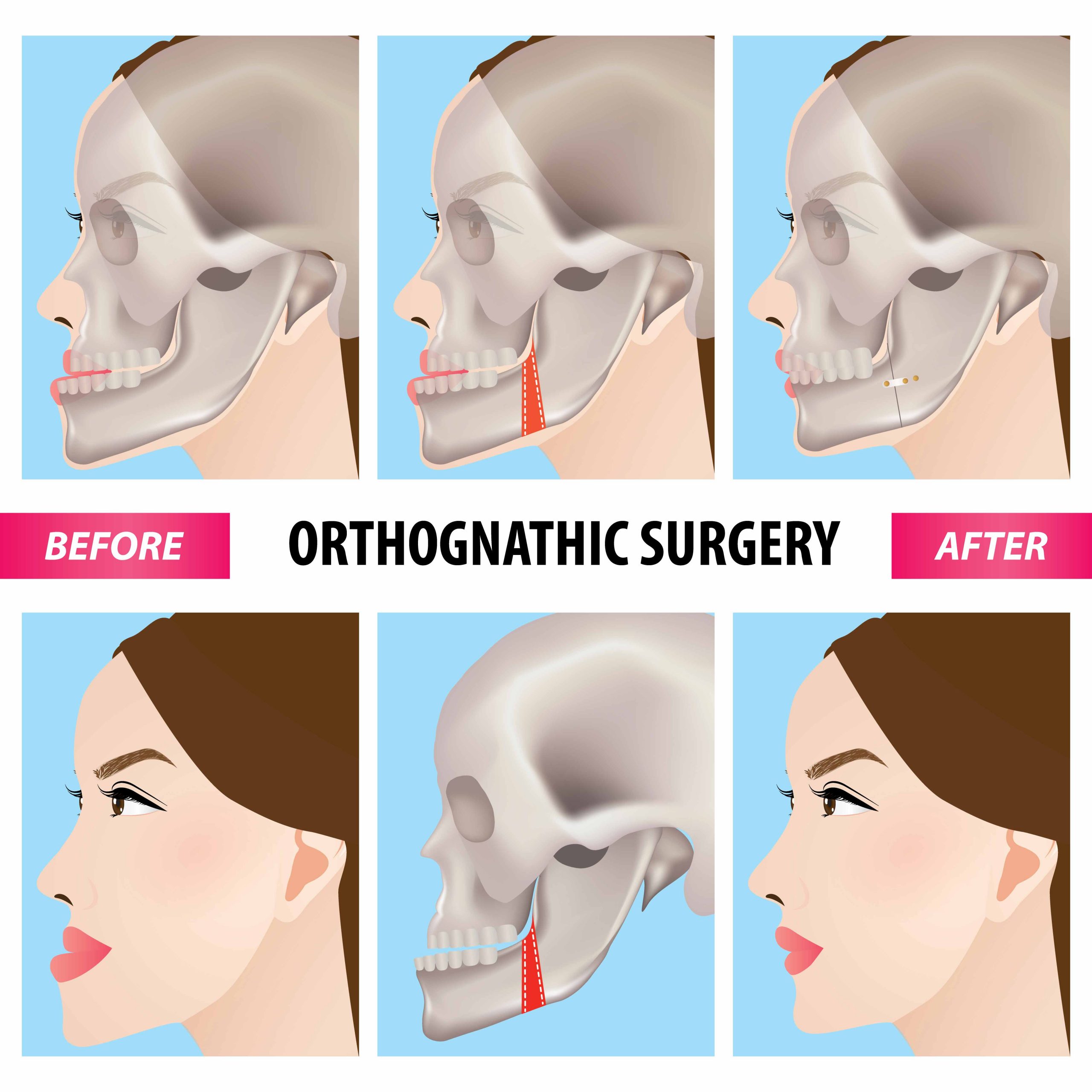 Orthognathic jaw surgery in Turkey showing pre and post-operative facial alignment