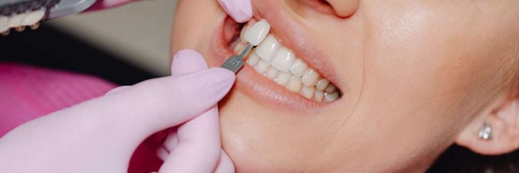 Laminate Veneer in Turkey – Natural-looking, aesthetic dental transformation in Istanbul