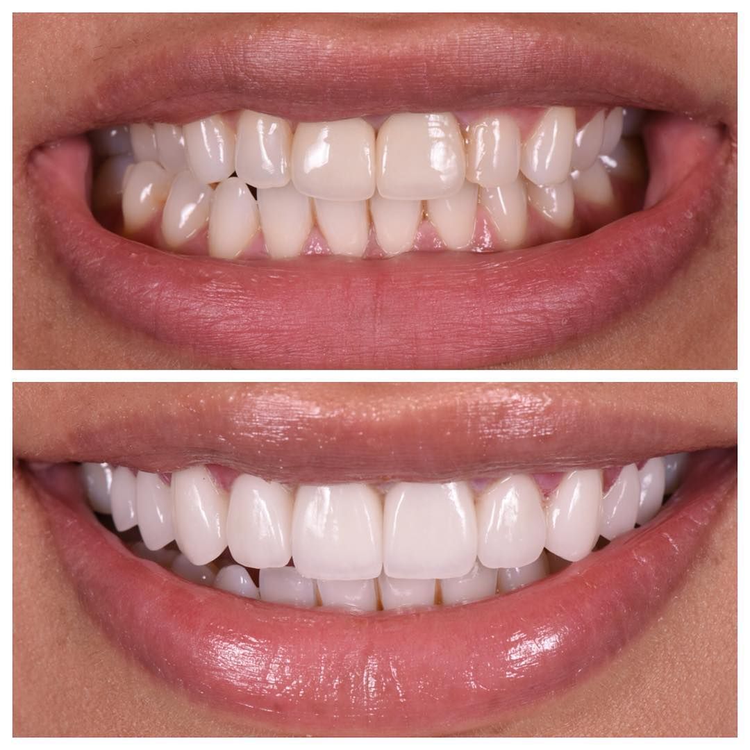 Laminate Veneer in Turkey – Full smile transformation with minimal tooth preparation