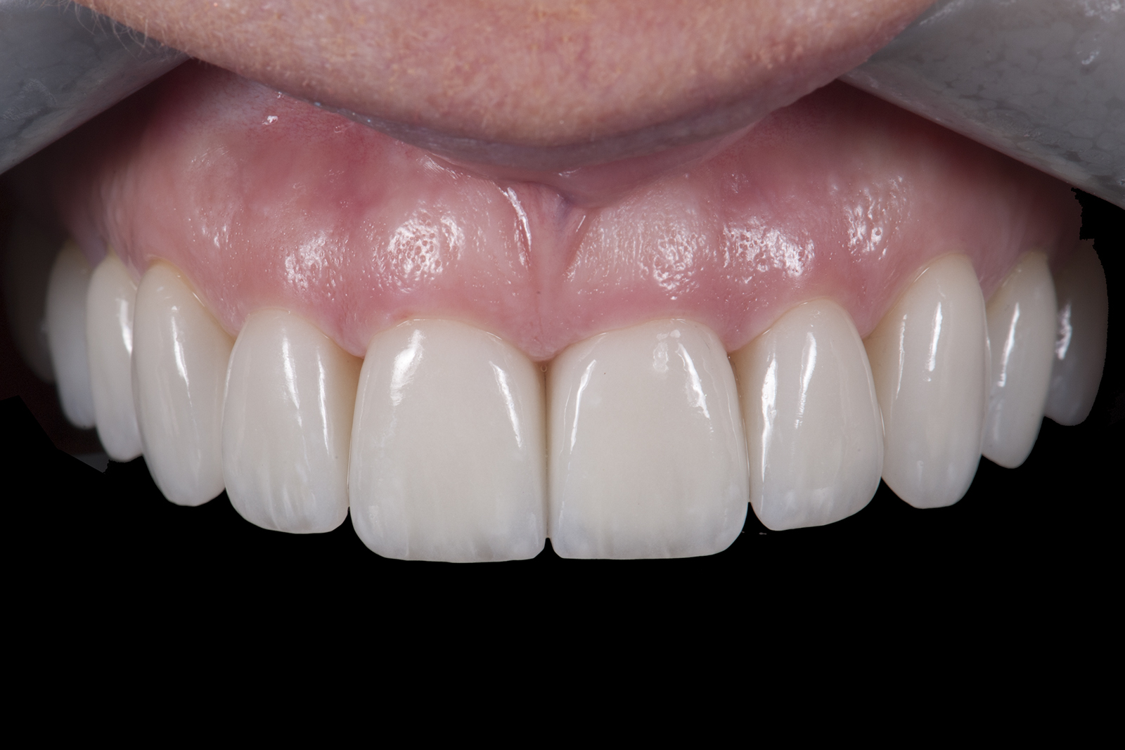 Before and after results of Laminate Veneer in Turkey – natural aesthetic outcome