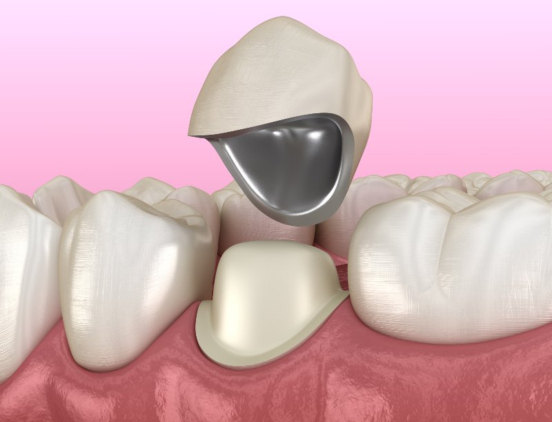 Before and after results of Metal Supported Porcelain in Turkey – natural aesthetic outcome