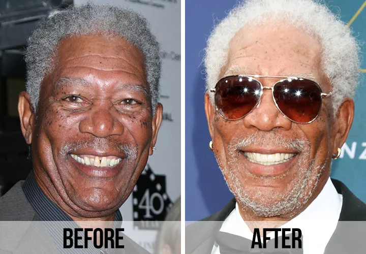 Morgan Freeman teeth before and after Hollywood Smile transformation in Turkey