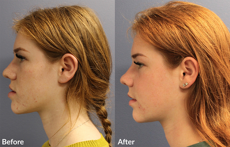 Orthognathic Surgery in Turkey – 3D imaging and surgical planning process