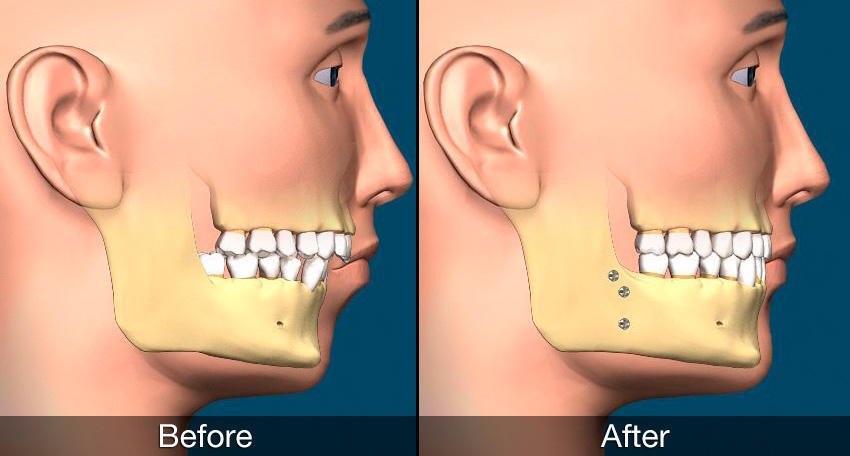 Orthognathic Surgery in Turkey – Istanbul skyline during recovery and dental tourism