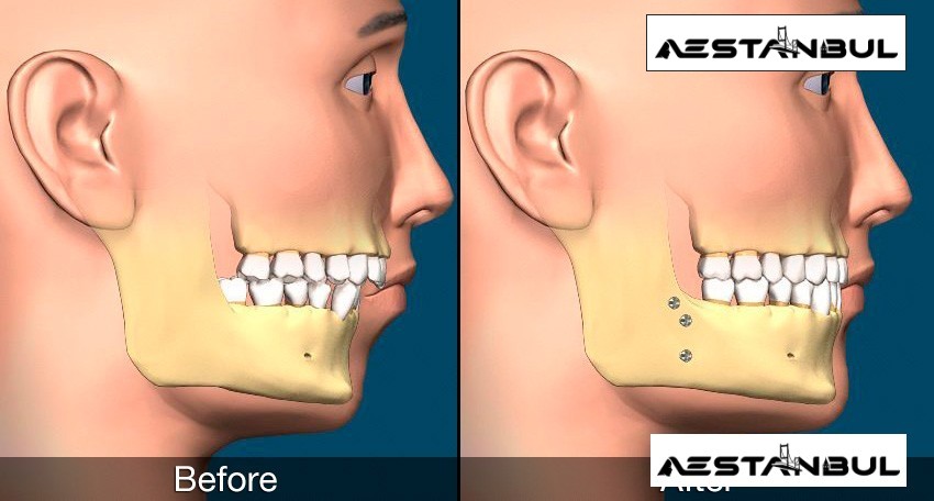 Jaw Surgery Recovery - Jaw Surgery Recovery: What International Patients Should Know