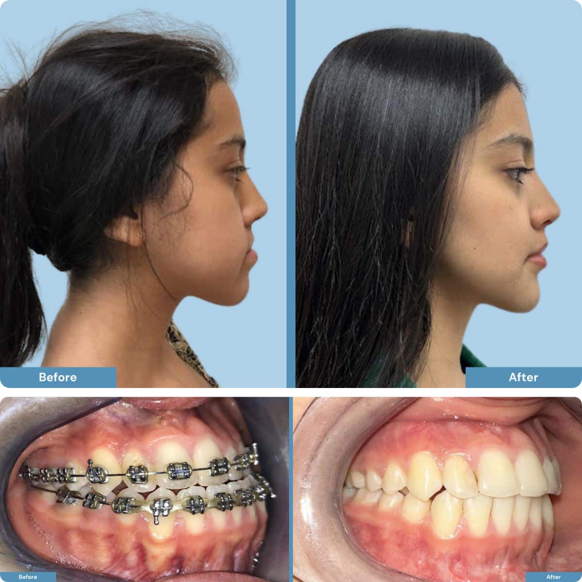 Orthognathic Surgery in Turkey – Jaw correction for facial balance and function