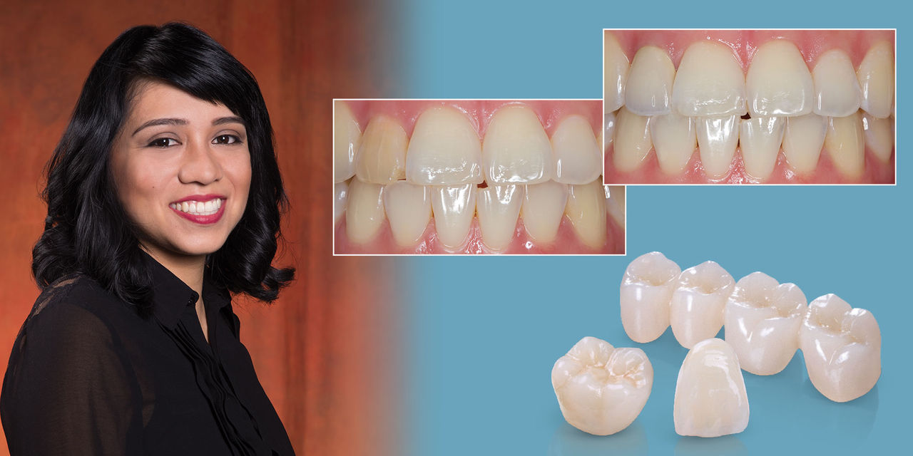 Porcelain Fused to Metal Crown in Turkey showing before and after results