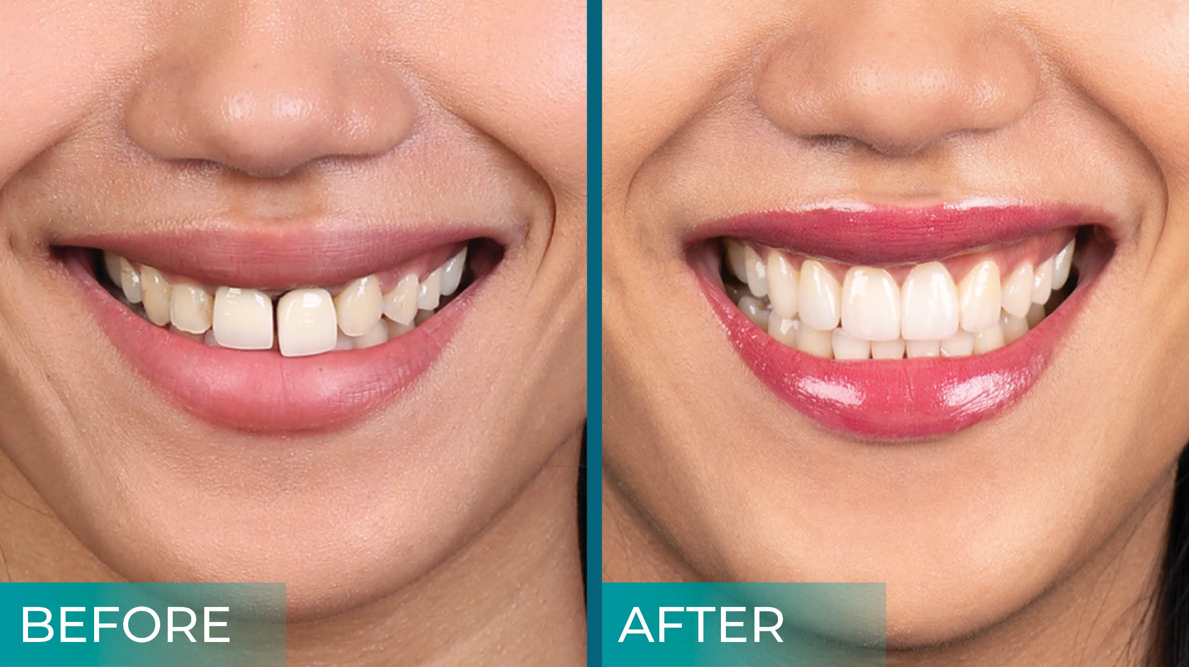 Porcelain Fused to Metal Crown in Turkey – Natural-looking, durable dental restoration in Istanbul