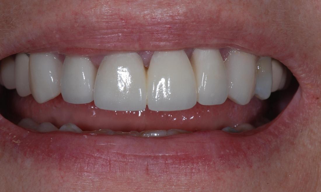 Porcelain Fused to Metal Crown in Turkey – Natural aesthetics and strong dental restoration
