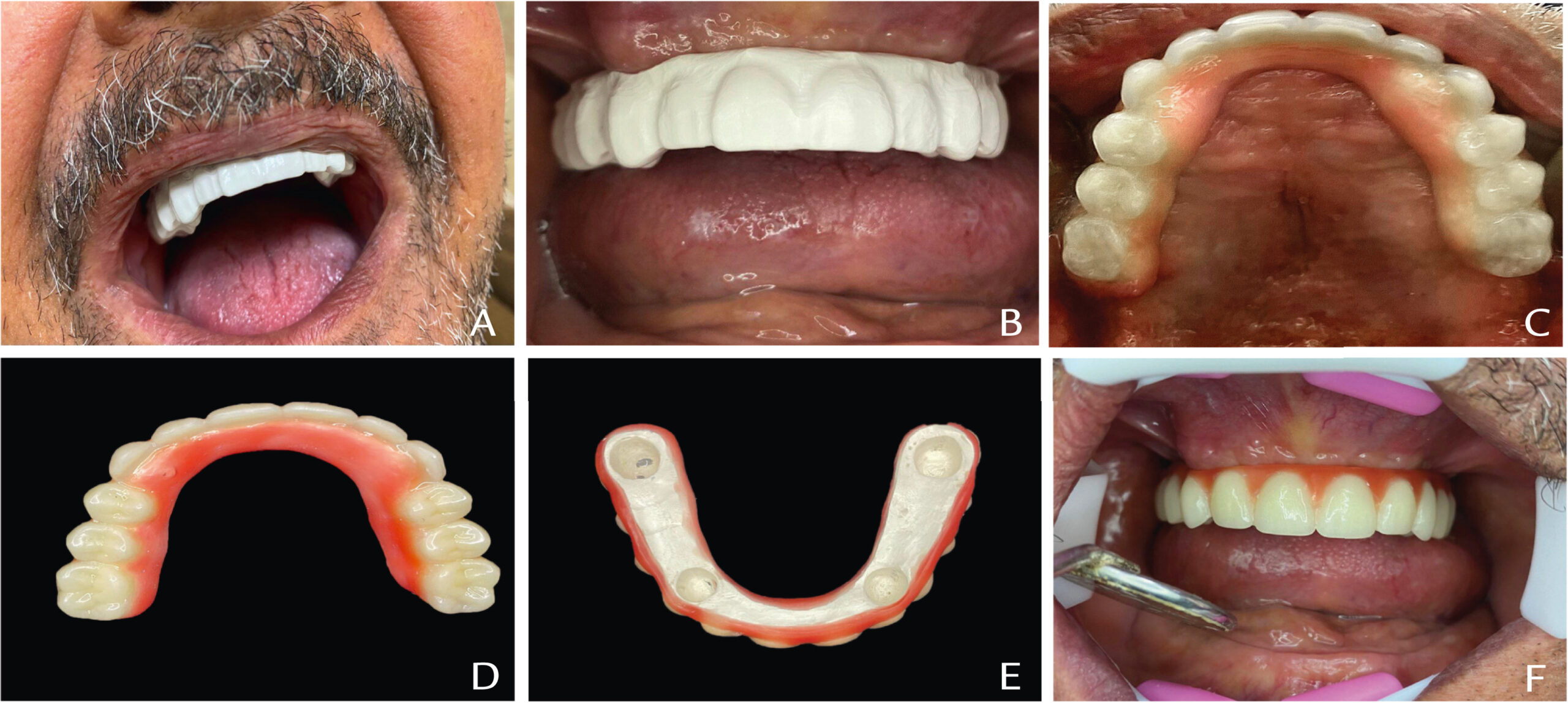 Before and after Prosthesis Treatment in Turkey – natural aesthetic outcome
