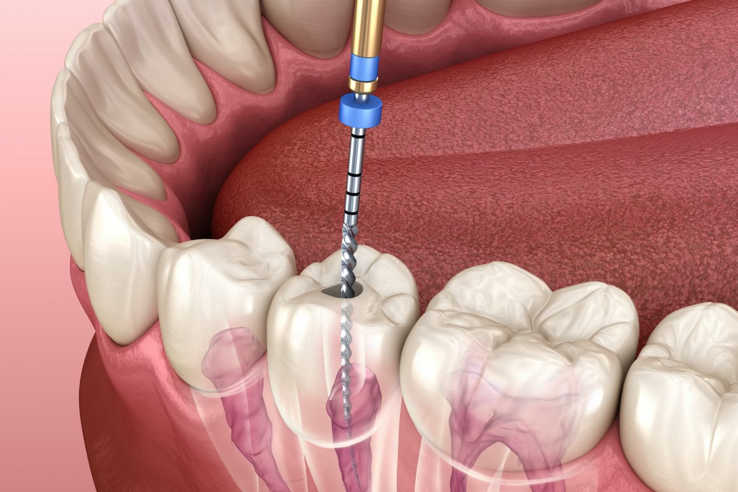 Root Canal Treatment in Turkey – Istanbul skyline during dental tourism