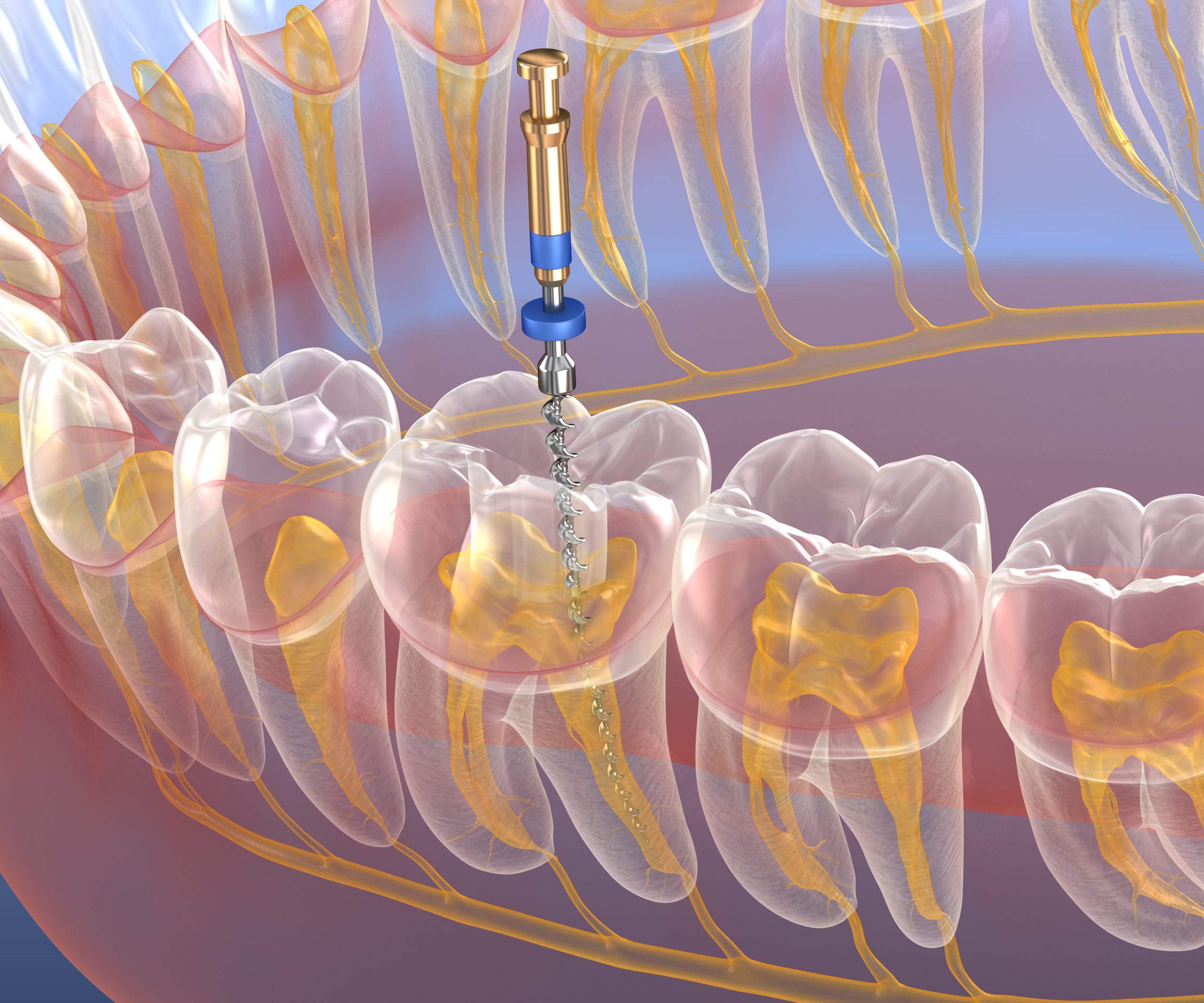 Before and after Root Canal Treatment in Turkey – saved natural tooth with full function