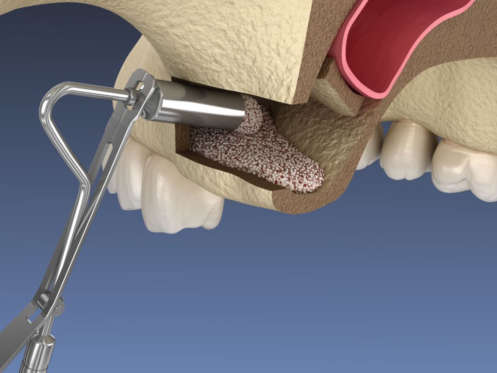 Sinus Lift in Turkey – Bone augmentation before dental implant placement