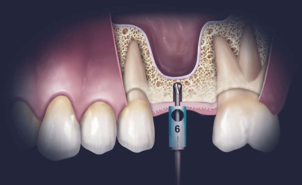 Why Some Patients Need Sinus Lift Before Implants