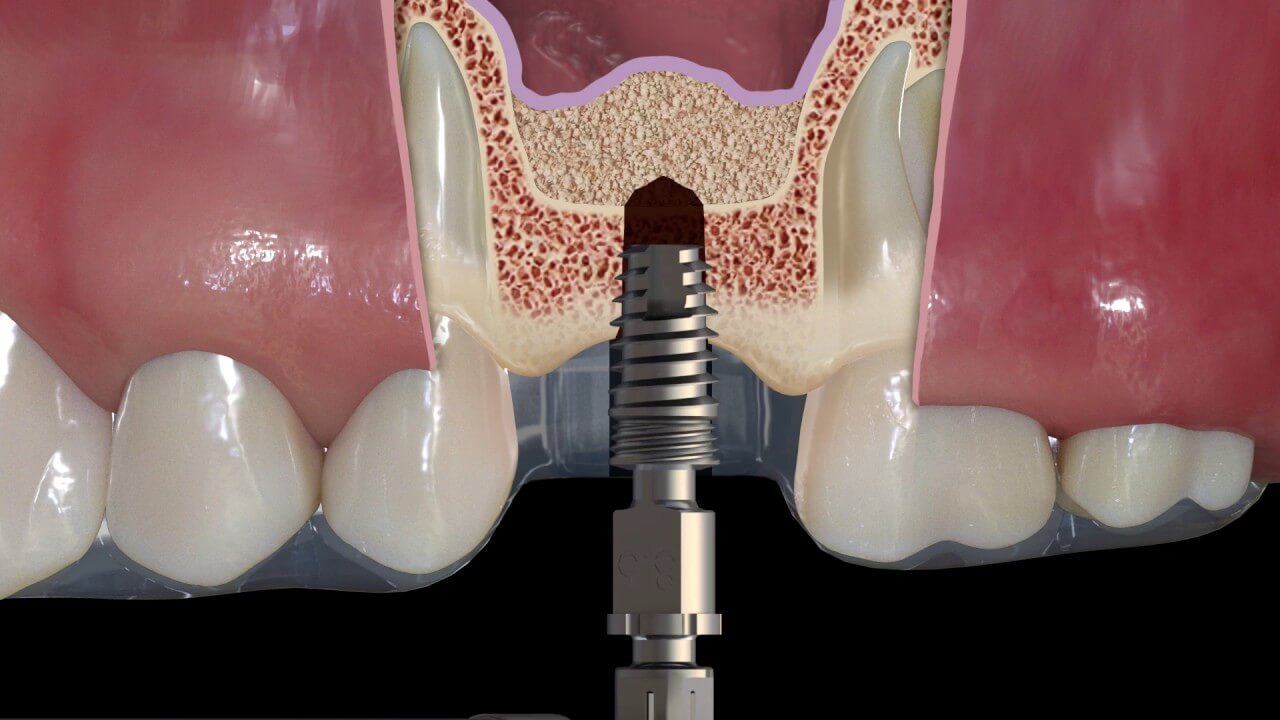 Sinus Lift in Turkey – Advanced bone augmentation for successful dental implants