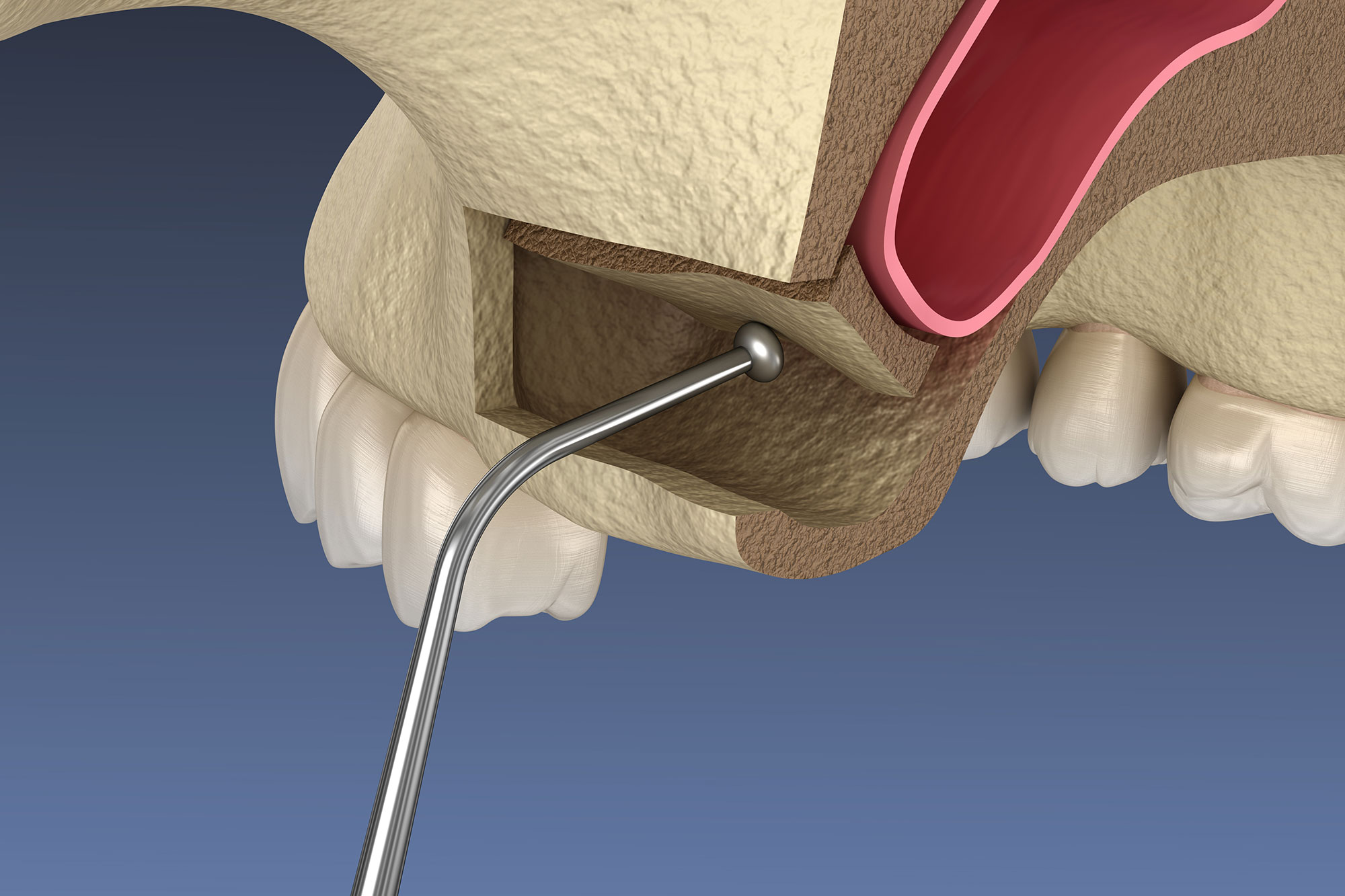 Sinus Lift procedure in Turkey showing bone augmentation and implant preparation