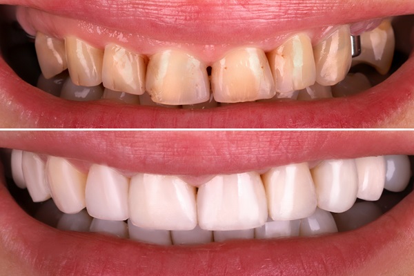 Before and after Smile Makeover in Turkey showing full dental transformation